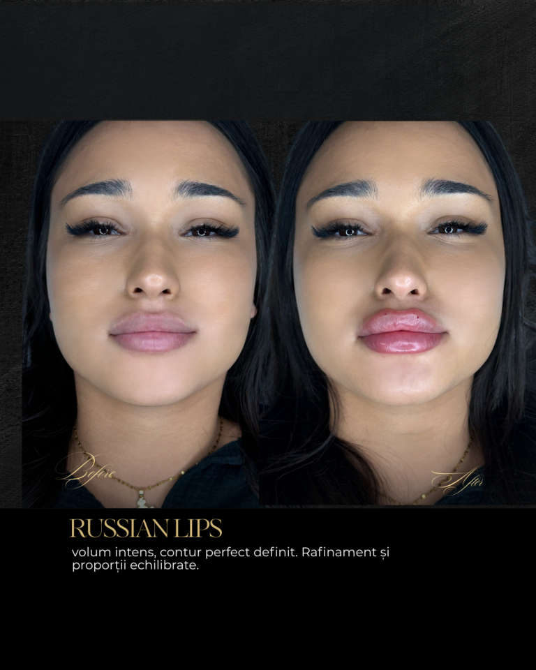srour aesthetics-lip augmentation-before-after