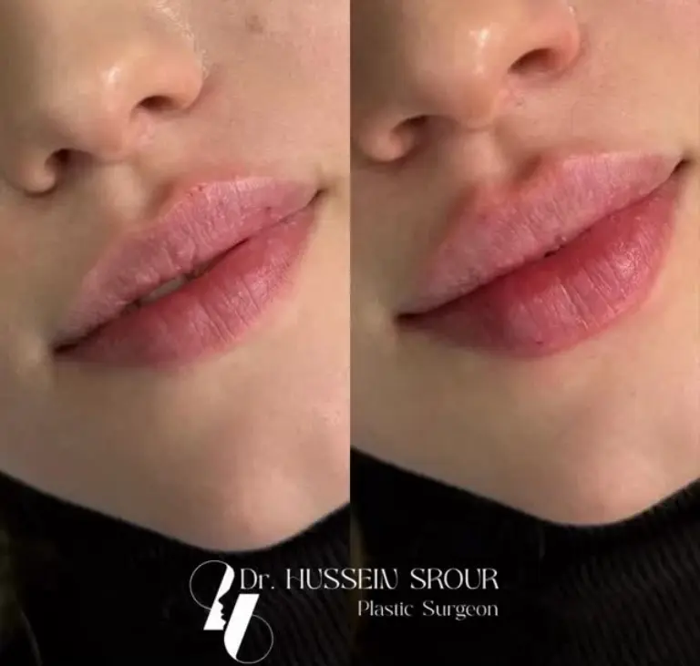 dr hussein srour lip augmentation 1 before after