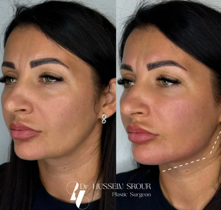 dr hussein srour neck augmentation before after