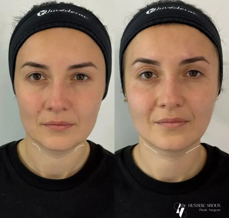 dr husseins rour neck augmentation before after