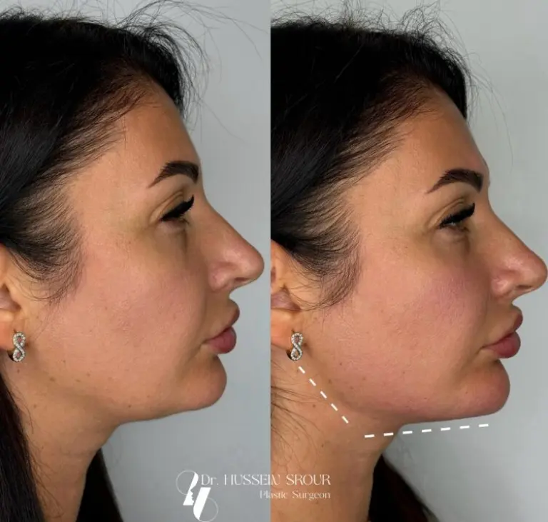 dr srour hussein neck augmentation before after