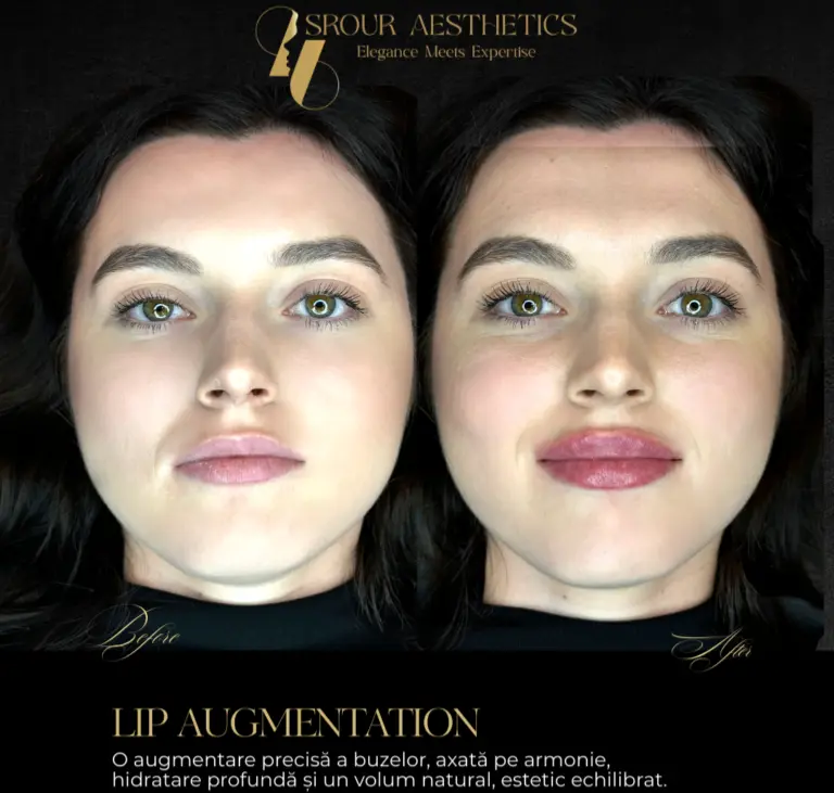 lip augmentation dr srour hussein before after