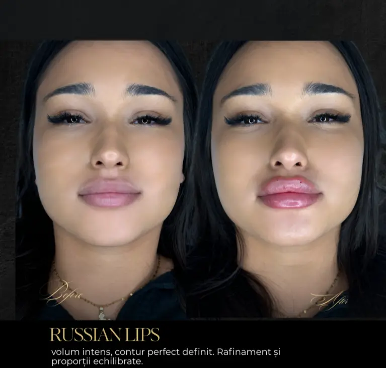 srour-aesthetics-lip-augmentation-before-after